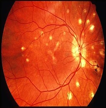 Diseases of the eye and adnexa 